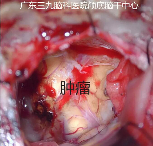 左侧小脑软化灶会引起头疼吗_左侧小脑半球脑软化灶_左侧小脑半球小软化灶形成